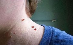 脖子上长疣是什么原因引起的